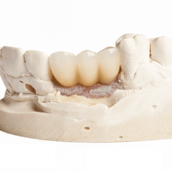 Screw Retained Restoration